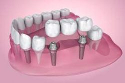 Affordable Dental Implants in Houston