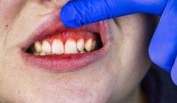 Periodontitis: Symptoms, Causes, and Treatments