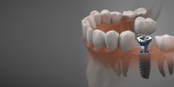 Dental Implant Treatment in Houston, TX