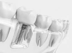 Dental Implant Near Me