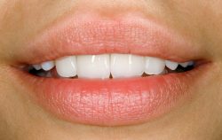 Porcelain Veneers in Surfside, Miami