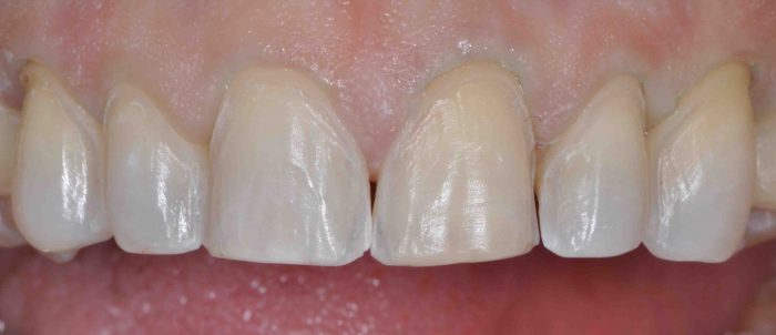 how much do porcelain veneers cost?