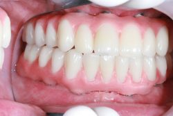 Affordable Dental Implants Near Me