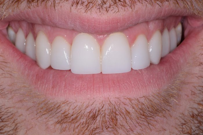 Temporary Veneers Vs No Prep Veneers