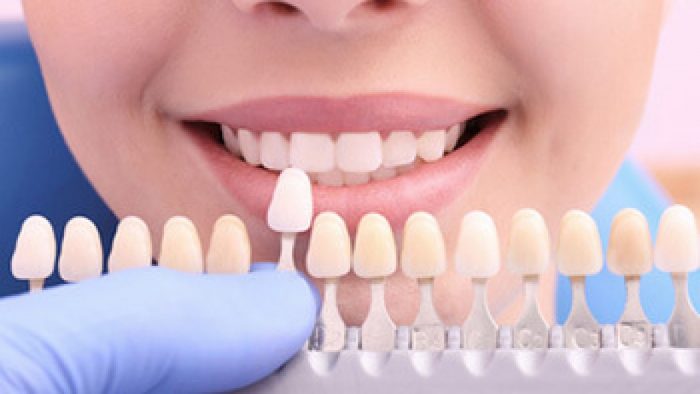 Dental Veneers in Houston, TX