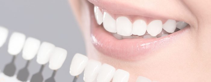 Best Dental Veneers in Houston, TX