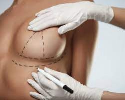 Breast Implants Surgery in Marbella