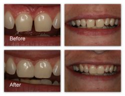 Fix Cavity on Front Tooth | Composite Front Tooth Cavity Filling or Bonding