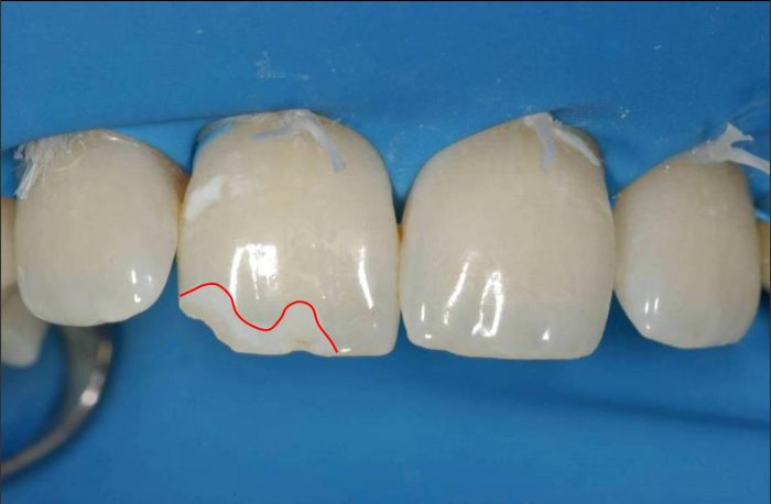 Fix Cavity on Front Tooth | Composite Front Tooth Cavity Filling or Bonding