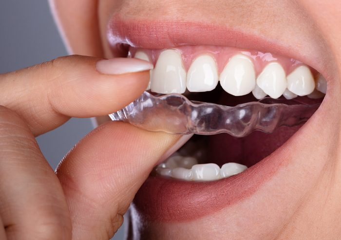 Find an Invisalign Doctor Near Me