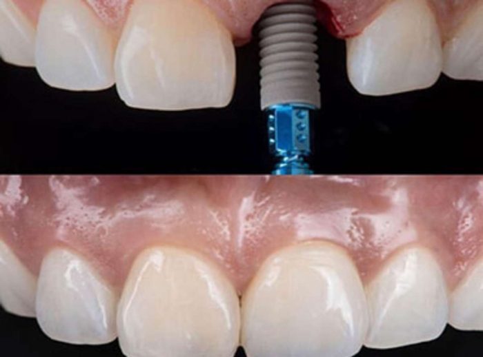 How much does a single tooth implant cost?