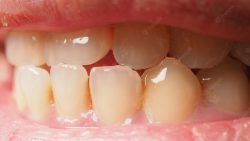 What is a Temporary Tooth Filling?