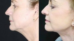 Double Chin/Neck Fat Removal