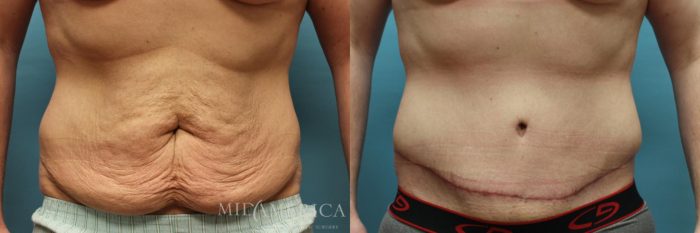 Tummy Tuck Before and After Pictures