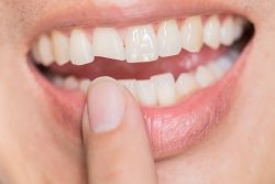 Affordable Dental Implant Specialist in Houston