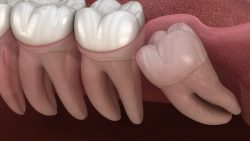 Impacted Wisdom Tooth Extraction