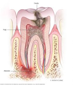 What Causes Tooth Infection?