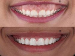 Gummy Smile Surgery Near Me