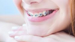 Affordable Dental Braces In Miami, FL