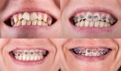 Affordable Dental Braces Near Me