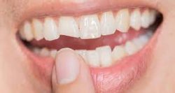 Chipped Tooth Repair in Houston, TX