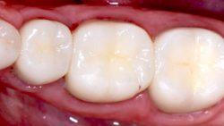 Types of Dental Fillings | Porcelain Composite Fillings | Amalgam fillings