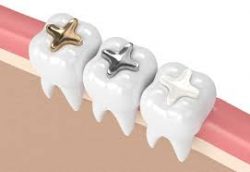 Types of Dental Fillings | Porcelain Composite Fillings | Amalgam fillings