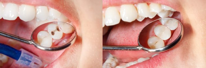 Types of Dental Fillings | Porcelain Composite Fillings | Amalgam fillings