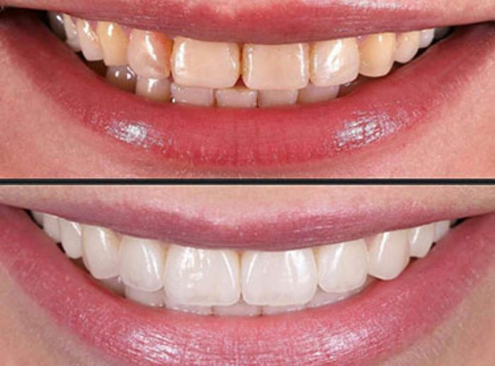 Porcelain Veneers Near Me