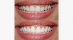 How much would gum contouring cost on a single tooth?