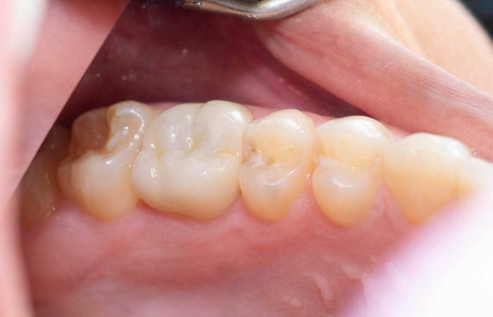 Dental Crowns Near Me in Houston, TX