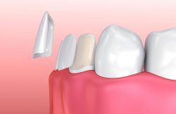 Dental Implants Near Me