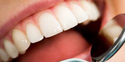Finding the Best Teeth Whitening Dentist in Houston TX – URBN Dental