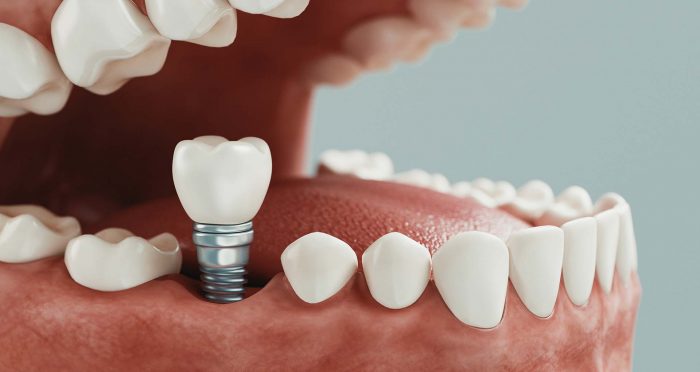 The Top-Rated Houston Dentist & Dental Implant Specialist | Urbn Dental
