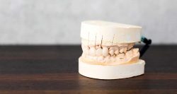 What Can You Not Eat with Dental Crown | Temporary Crowns on Front Teeth