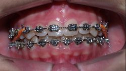 Find The Best Orthodontist In Miami Fl