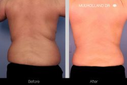 Liposuction Results Before And After