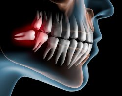 Impacted Wisdom Tooth Extraction