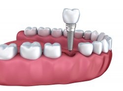 Dental Implants in Sunny Isles