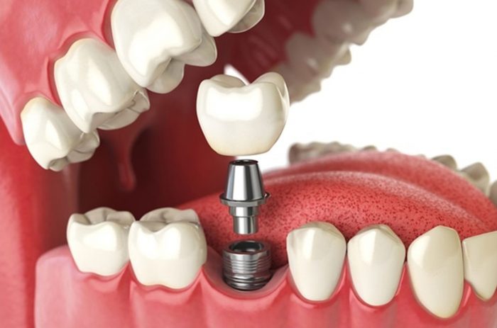 Dental Implants Near Me