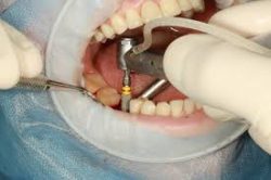 Dental Implants For Multiple Missing Teeth