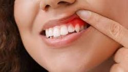 Severe Gingivitis Treatment And Prevention
