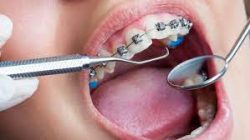 Affordable Dental Braces Near Me