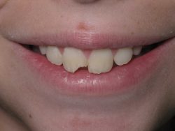 Fix Cavity on Front Tooth | Composite Front Tooth Cavity Filling or Bonding