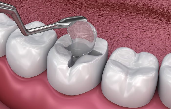 What is a Temporary Tooth Filling?