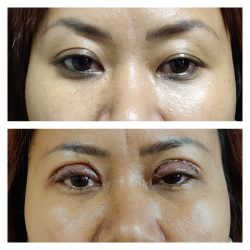 How Much Does Eye Lift Surgery Cost?