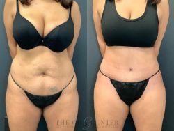 Tummy Tuck Houston Cost