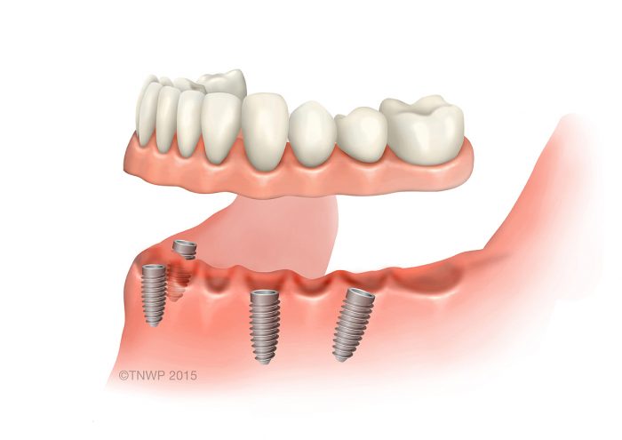 Dental Implants Service