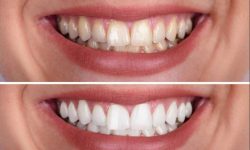 Teeth Whitening Near Me