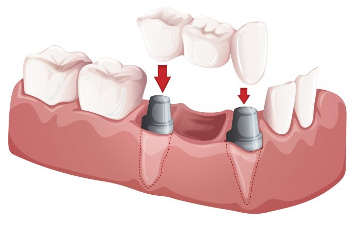 Dental Bridges Near me